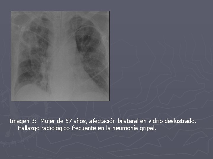 Imagen 3: Mujer de 57 años, afectación bilateral en vidrio deslustrado. Hallazgo radiológico frecuente