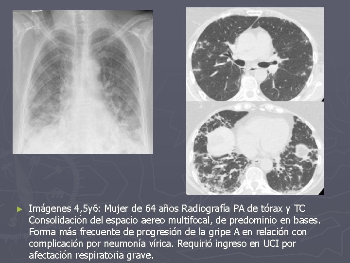 ► Imágenes 4, 5 y 6: Mujer de 64 años Radiografía PA de tórax