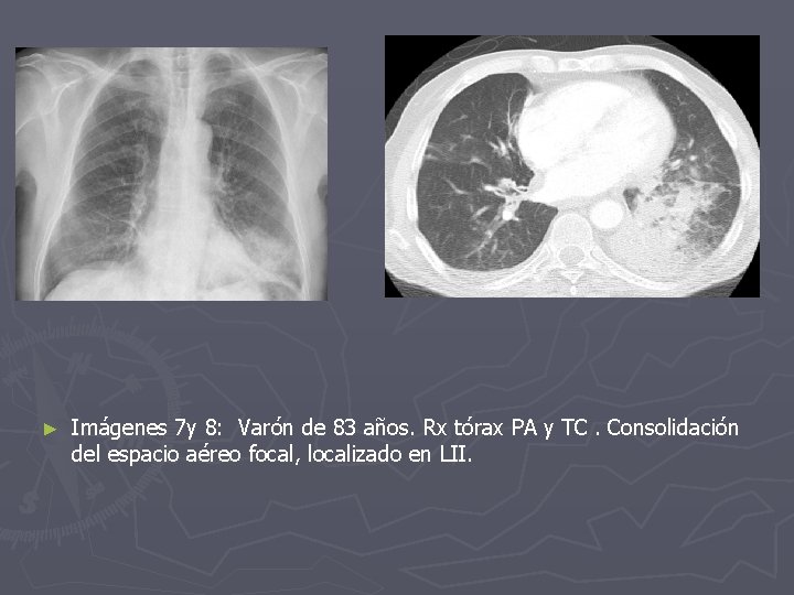 ► Imágenes 7 y 8: Varón de 83 años. Rx tórax PA y TC.