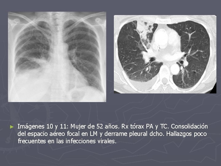 ► Imágenes 10 y 11: Mujer de 52 años. Rx tórax PA y TC.