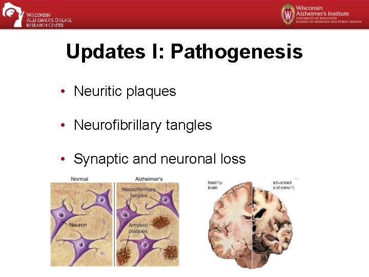 Updates I: Pathogenesis • Neuritic plaques • Neurofibrillary tangles • Synaptic and neuronal loss