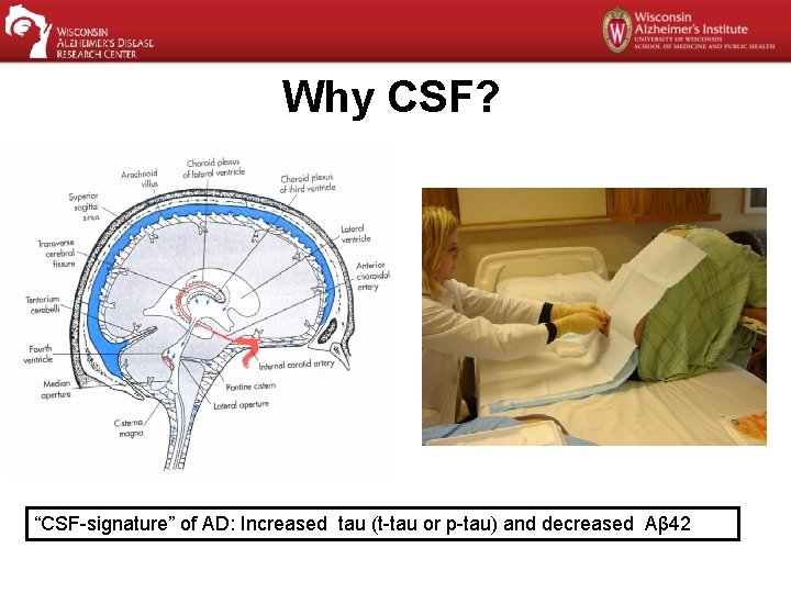 Why CSF? “CSF-signature” of AD: Increased tau (t-tau or p-tau) and decreased Aβ 42