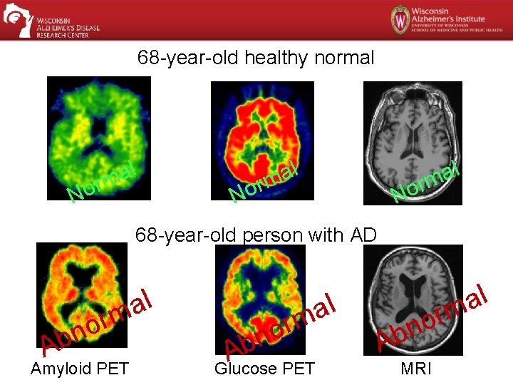 68 -year-old healthy normal l a rm No No 68 -year-old person with AD