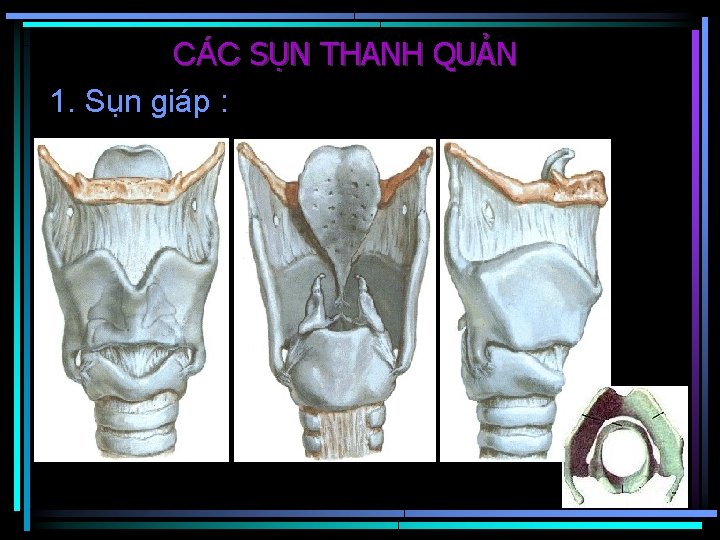 CÁC SỤN THANH QUẢN 1. Sụn giáp : 