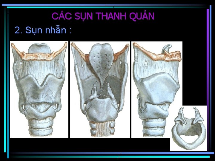 CÁC SỤN THANH QUẢN 2. Sụn nhẫn : 