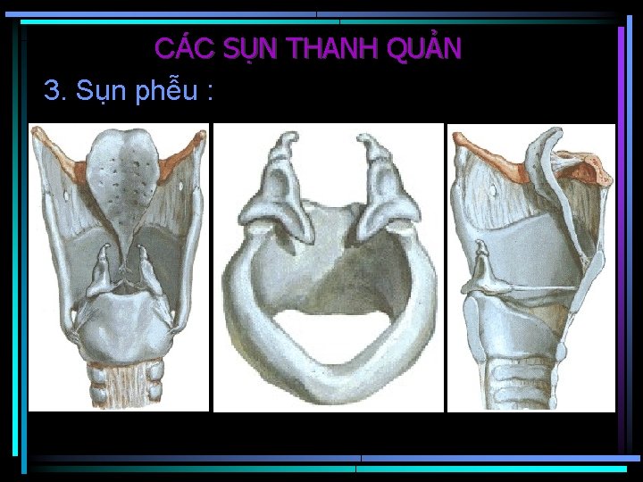 CÁC SỤN THANH QUẢN 3. Sụn phễu : 