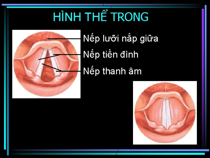 HÌNH THỂ TRONG Nếp lưỡi nắp giữa Nếp tiền đình Nếp thanh âm 