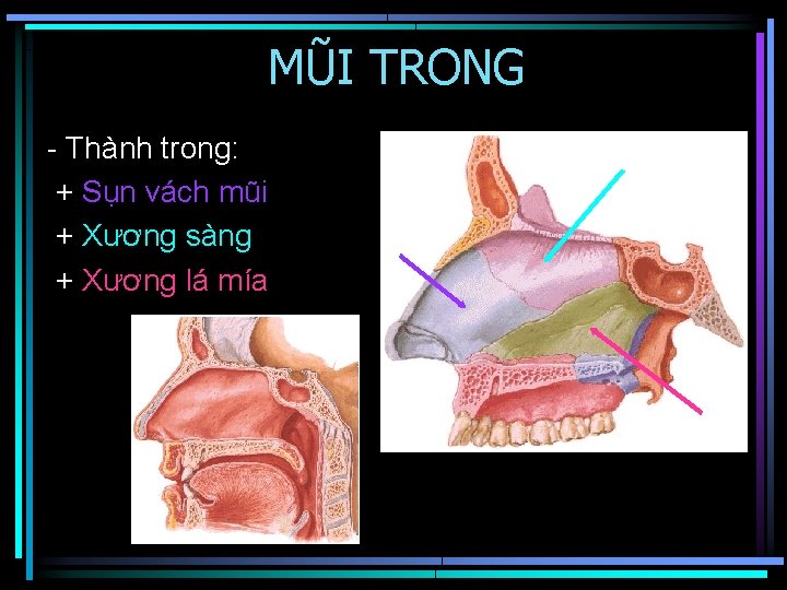 MŨI TRONG - Thành trong: + Sụn vách mũi + Xương sàng + Xương