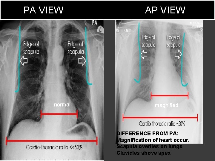 Diagnostic Imaging Normal Chest Anatomy On XR Technique