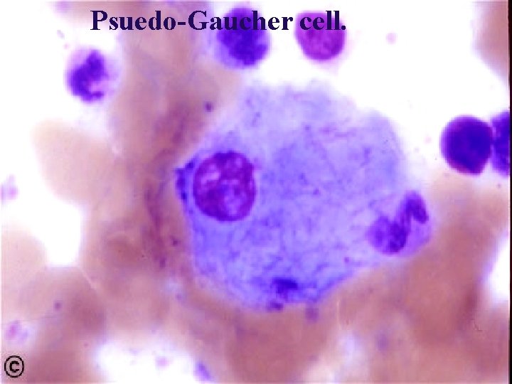 Psuedo-Gaucher cell. 