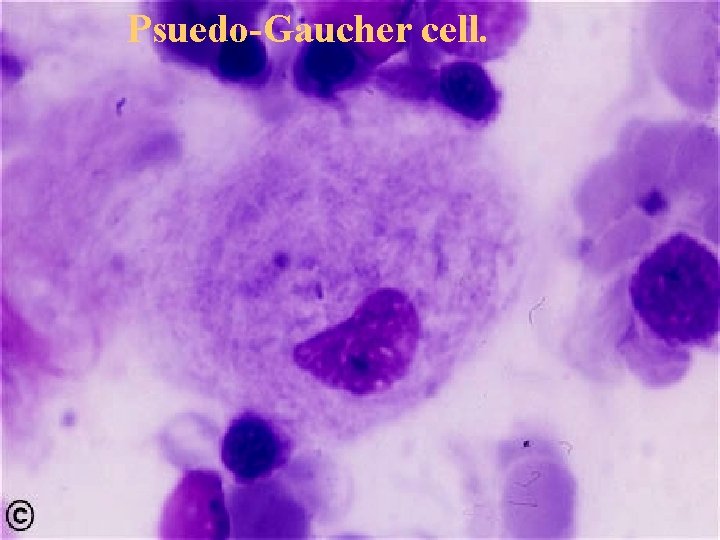 Psuedo-Gaucher cell. 