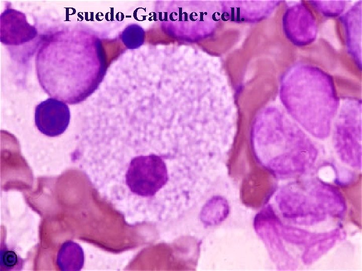 Psuedo-Gaucher cell. 