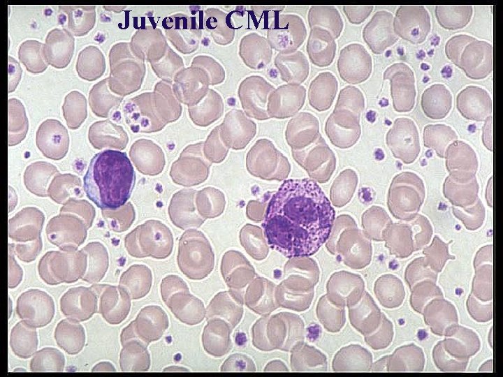 Juvenile CML 