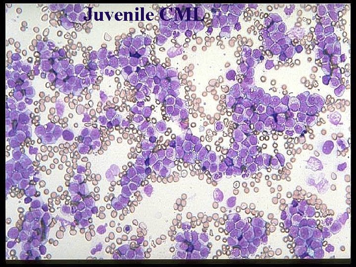 Juvenile CML 