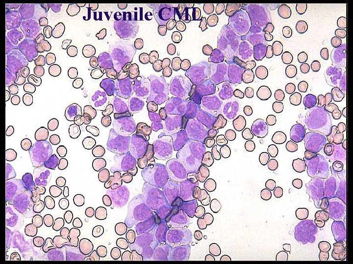 Juvenile CML 