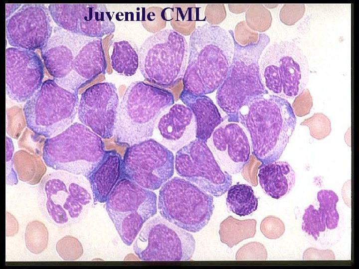 Juvenile CML 