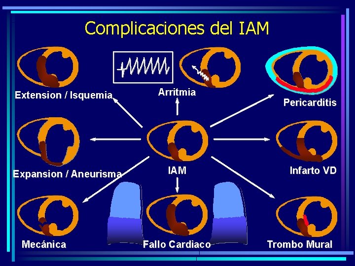 Complicaciones del IAM Extension / Isquemia Expansion / Aneurisma Mecánica Arritmia IAM Fallo Cardiaco