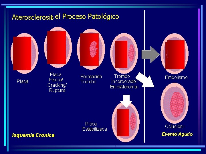 Aterosclerosis: el Proceso Patológico Placa Plaqu Placa Fisura/ Cracking/ Ruptura Rupture Thrombus Formación Trombo