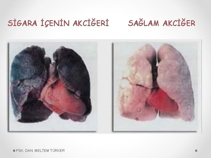 SİGARA İÇENİN AKCİĞERİ PSK. DAN. MELTEM TÜRKER SAĞLAM AKCİĞER 