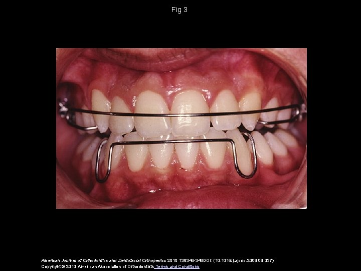 Fig 3 American Journal of Orthodontics and Dentofacial Orthopedics 2010 138346 -348 DOI: (10.