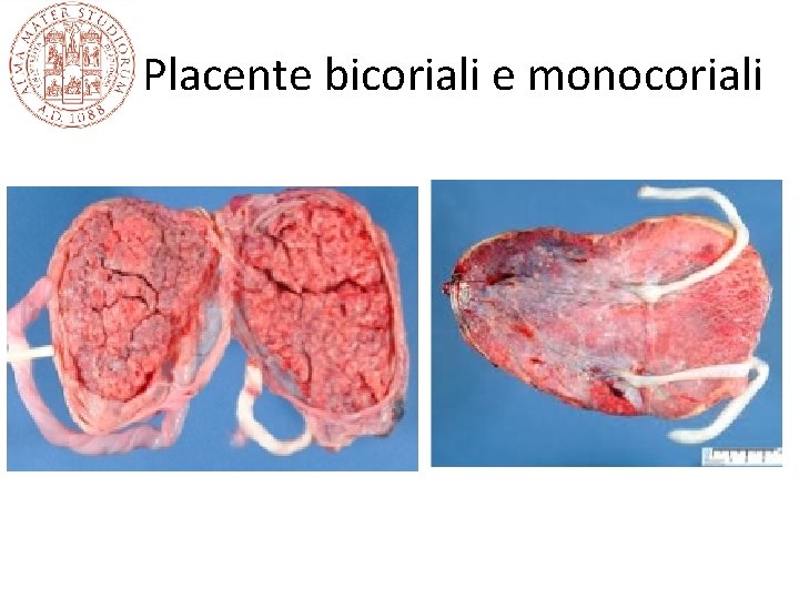 Placente bicoriali e monocoriali Placente bicoriali e monocoriali