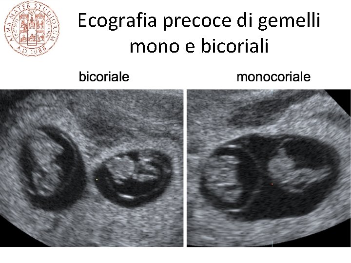 Ecografia precoce di gemelli mono e bicoriali Ecografia precoce di gemelli mono e bicoriali