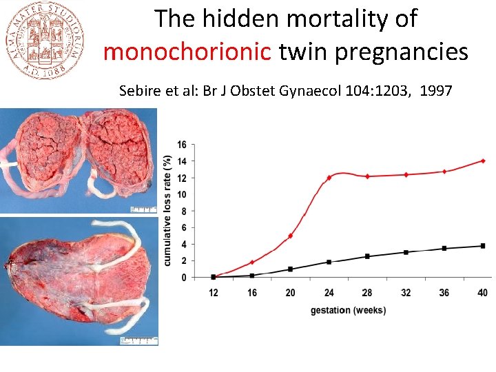The hidden mortality of monochorionic twin pregnancies Sebire et al: Br J Obstet Gynaecol The hidden mortality of monochorionic twin pregnancies Sebire et al: Br J Obstet Gynaecol
