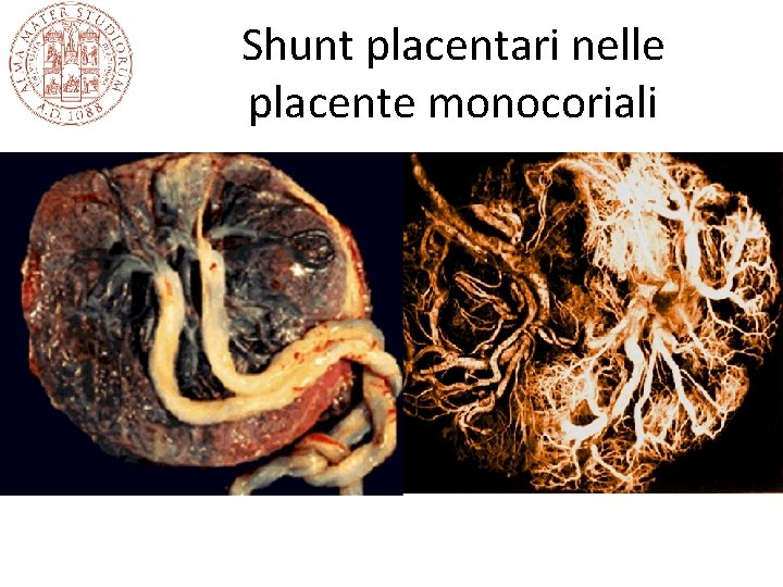 Shunt placentari nelle placente monocoriali Shunt placentari nelle placente monocoriali