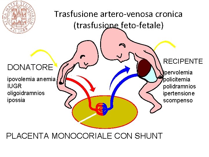 Trasfusione artero-venosa cronica (trasfusione feto-fetale) DONATORE ipovolemia anemia IUGR oligoidramnios ipossia PLACENTA MONOCORIALE CON Trasfusione artero-venosa cronica (trasfusione feto-fetale) DONATORE ipovolemia anemia IUGR oligoidramnios ipossia PLACENTA MONOCORIALE CON