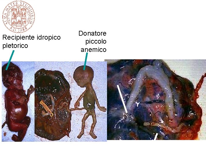 Recipiente idropico pletorico Donatore piccolo anemico Recipiente idropico pletorico Donatore piccolo anemico