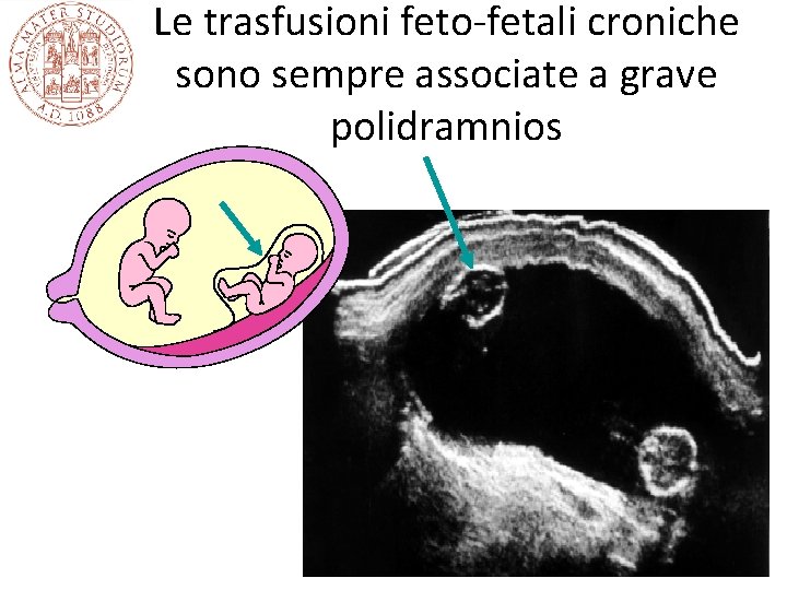 Le trasfusioni feto-fetali croniche sono sempre associate a grave polidramnios Le trasfusioni feto-fetali croniche sono sempre associate a grave polidramnios