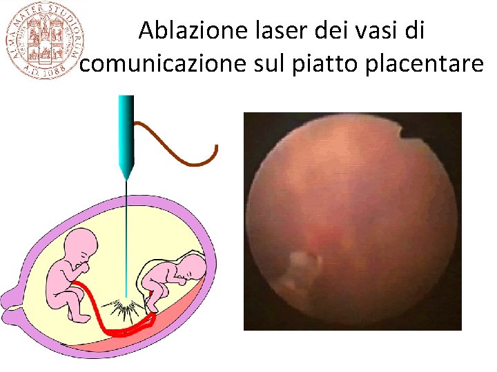 Ablazione laser dei vasi di comunicazione sul piatto placentare Ablazione laser dei vasi di comunicazione sul piatto placentare