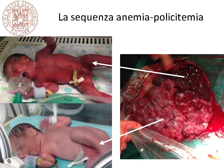 La sequenza anemia-policitemia La sequenza anemia-policitemia