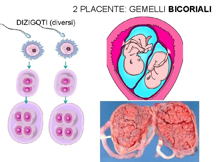 2 PLACENTE: GEMELLI BICORIALI 2 PLACENTE: GEMELLI BICORIALI