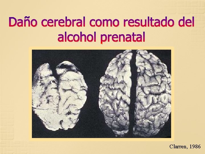 Daño cerebral como resultado del alcohol prenatal Clarren, 1986 