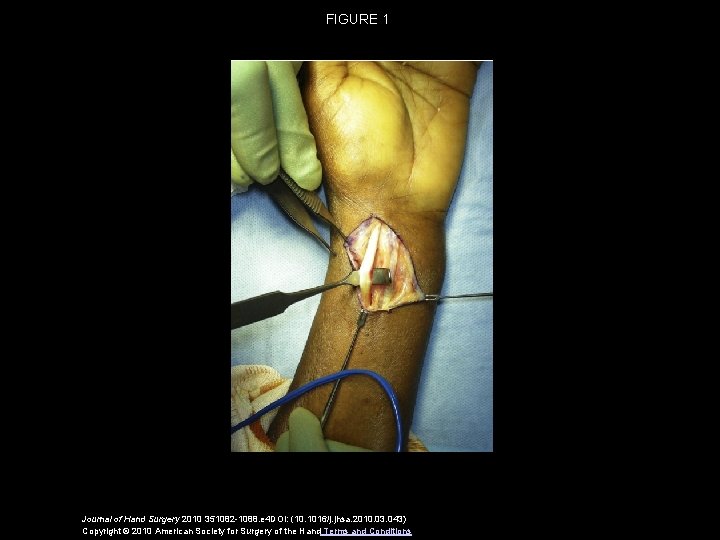 FIGURE 1 Journal of Hand Surgery 2010 351082 -1088. e 4 DOI: (10. 1016/j.