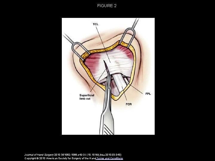 FIGURE 2 Journal of Hand Surgery 2010 351082 -1088. e 4 DOI: (10. 1016/j.