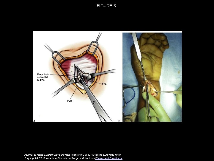 FIGURE 3 Journal of Hand Surgery 2010 351082 -1088. e 4 DOI: (10. 1016/j.