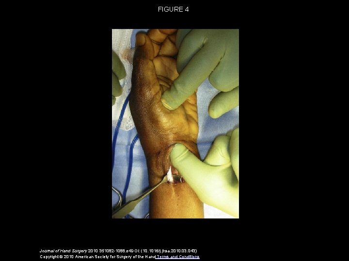 FIGURE 4 Journal of Hand Surgery 2010 351082 -1088. e 4 DOI: (10. 1016/j.