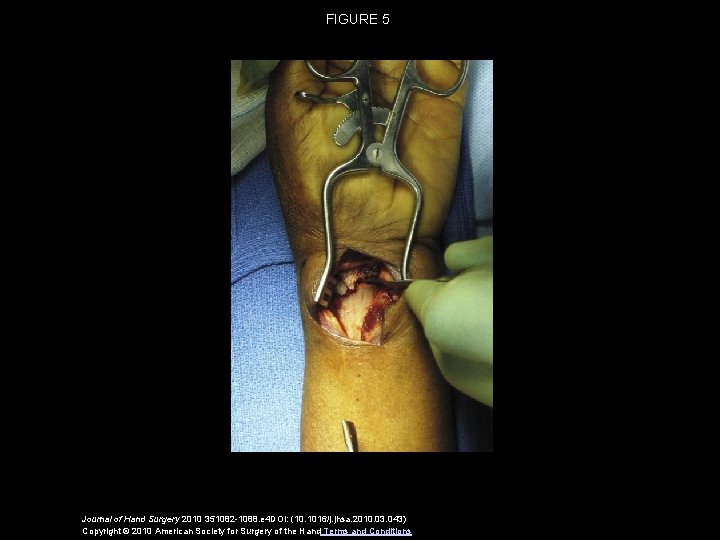 FIGURE 5 Journal of Hand Surgery 2010 351082 -1088. e 4 DOI: (10. 1016/j.