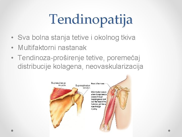 Tendinopatija • Sva bolna stanja tetive i okolnog tkiva • Multifaktorni nastanak • Tendinoza-proširenje