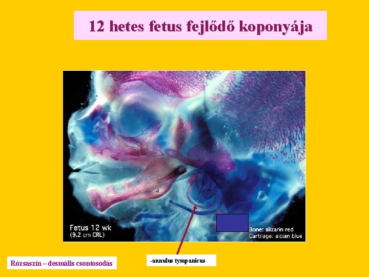 12 hetes fetus fejlődő koponyája Rózsaszín – desmális csontosodás -annulus tympanicus 