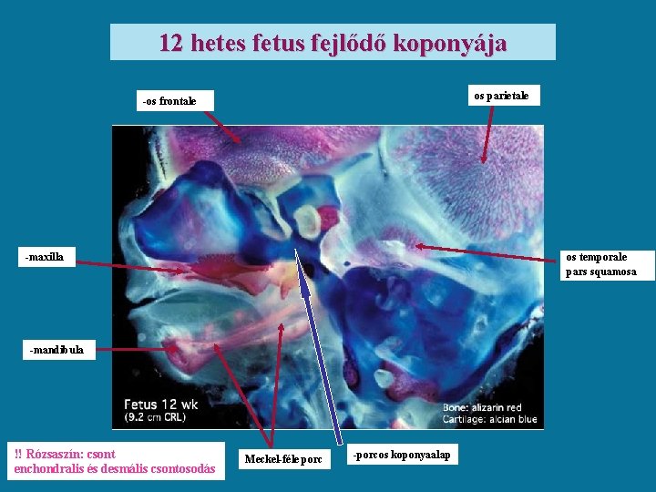 12 hetes fetus fejlődő koponyája os parietale -os frontale os temporale pars squamosa -maxilla