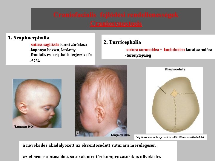Craniofacialis fejlődési rendellenességek Craniosynostosis 1. Scaphocephalia -sutura sagittalis korai záródása -koponya hosszú, keskeny -frontalis