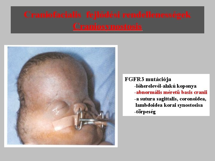 Craniofacialis fejlődési rendellenességek Craniosynostosis FGFR 3 mutációja -lóherelevél-alakú koponya -abnormális méretű basis cranii -a