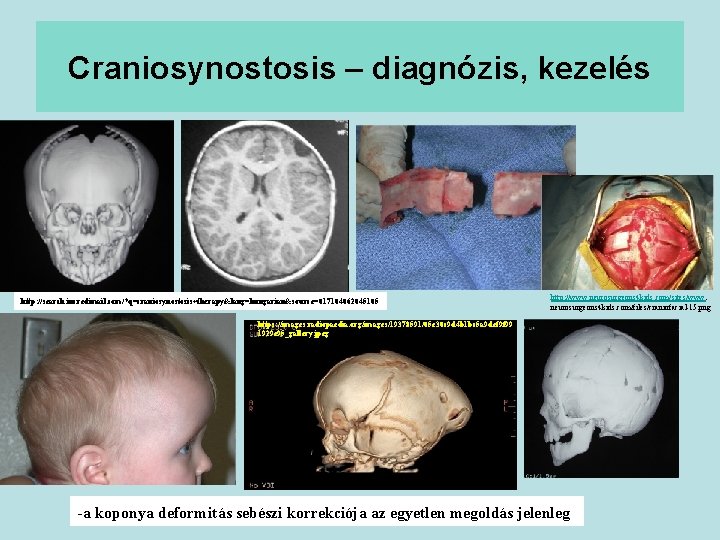 Craniosynostosis – diagnózis, kezelés http: //search. incredimail. com/? q=craniosynostosis+therapy&lang=hungarian&source=017104062045105 http: //www. neurosurgeons 4 kids.