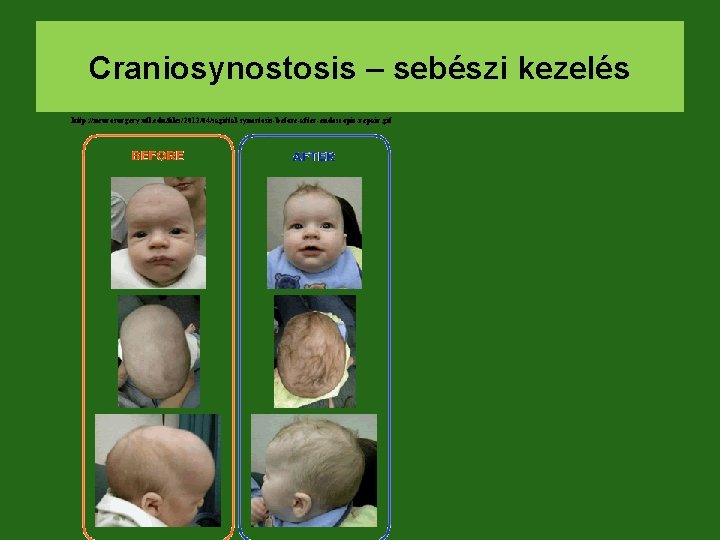 Craniosynostosis – sebészi kezelés http: //neurosurgery. ufl. edu/files/2012/04/sagittal-synostosis-before-after-endoscopic-repair. gif 