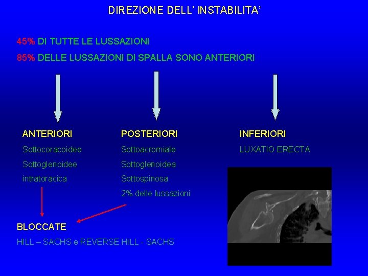 DIREZIONE DELL’ INSTABILITA’ 45% DI TUTTE LE LUSSAZIONI 85% DELLE LUSSAZIONI DI SPALLA SONO DIREZIONE DELL’ INSTABILITA’ 45% DI TUTTE LE LUSSAZIONI 85% DELLE LUSSAZIONI DI SPALLA SONO