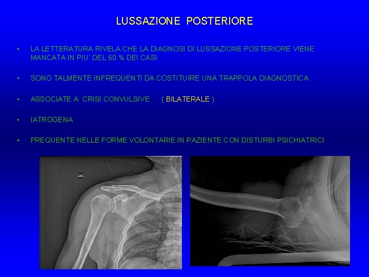LUSSAZIONE POSTERIORE • LA LETTERATURA RIVELA CHE LA DIAGNOSI DI LUSSAZIONE POSTERIORE VIENE MANCATA LUSSAZIONE POSTERIORE • LA LETTERATURA RIVELA CHE LA DIAGNOSI DI LUSSAZIONE POSTERIORE VIENE MANCATA
