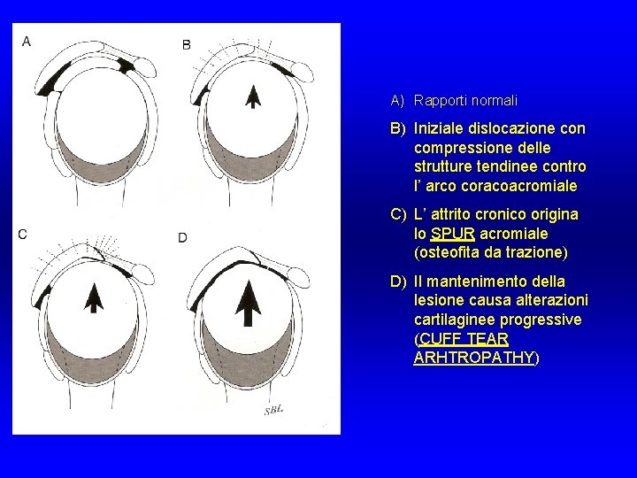 A) Rapporti normali B) Iniziale dislocazione con compressione delle strutture tendinee contro l’ arco A) Rapporti normali B) Iniziale dislocazione con compressione delle strutture tendinee contro l’ arco